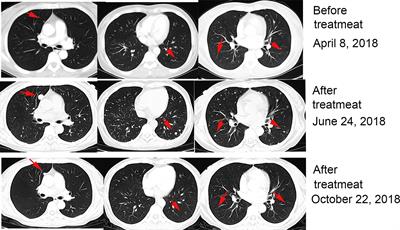 Advanced Renal-Cell Carcinoma Pseudoprogression After Combined Immunotherapy: Case Report and Literature Review